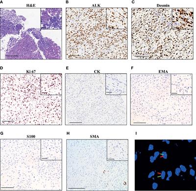 Durable Clinical Response to ALK Tyrosine Kinase Inhibitors in Epithelioid Inflammatory Myofibroblastic Sarcoma Harboring PRRC2B-ALK Rearrangement: A Case Report